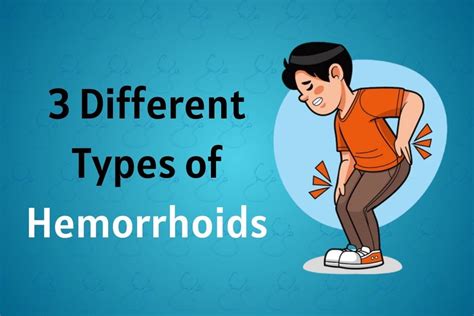 Hemorrhoids